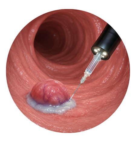 Endoscopic Sclerotherapy